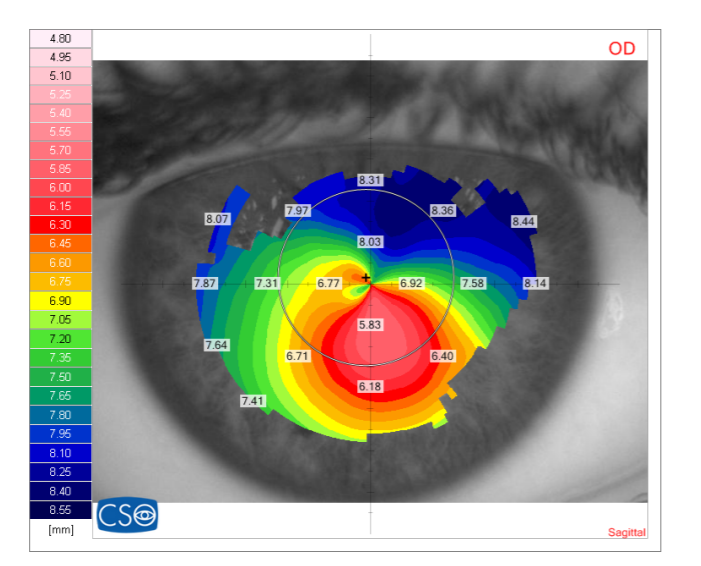 ICD TORIC 16.5 OVAL KERATOCONUS